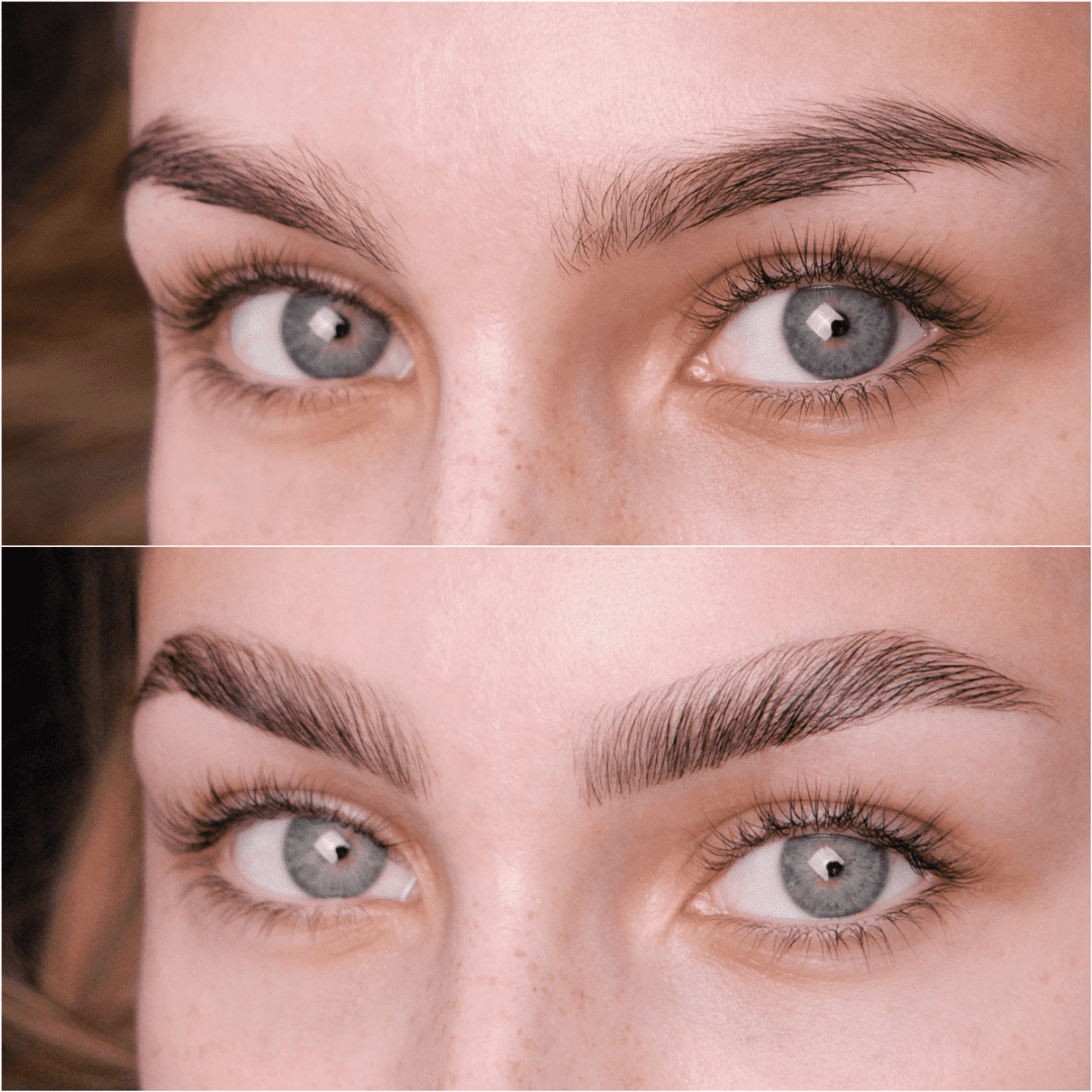alt
lifting des sourcils avant et après